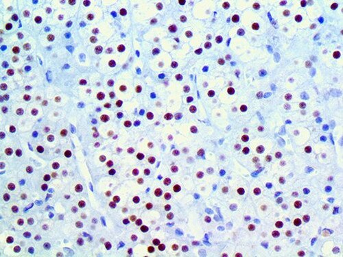 IHC of TFE3 on an FFPE Testicular Cancer Tissue